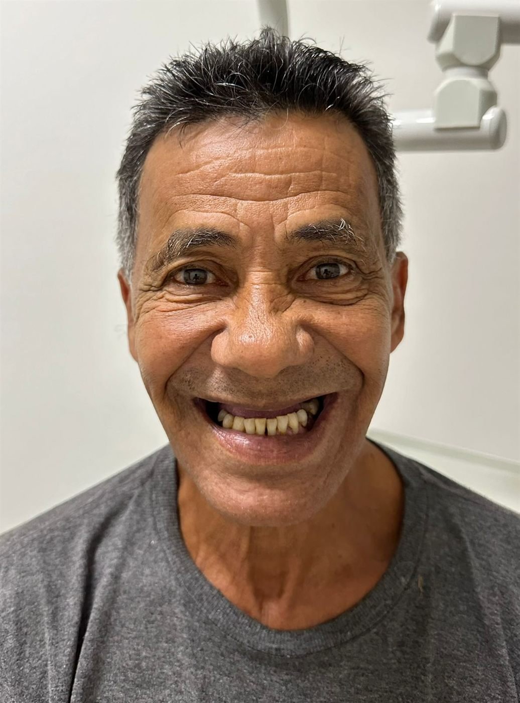 Paciente antes do tratamento, com ausência de dentes na arcada superior.