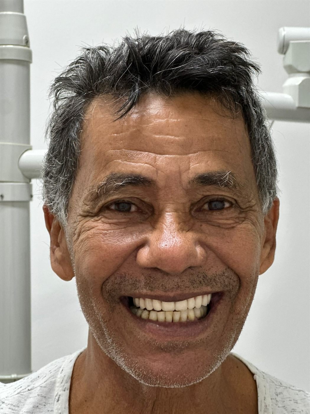 O mesmo paciente depois da reabilitação com protocolo superior, sorrindo com a arcada completa.