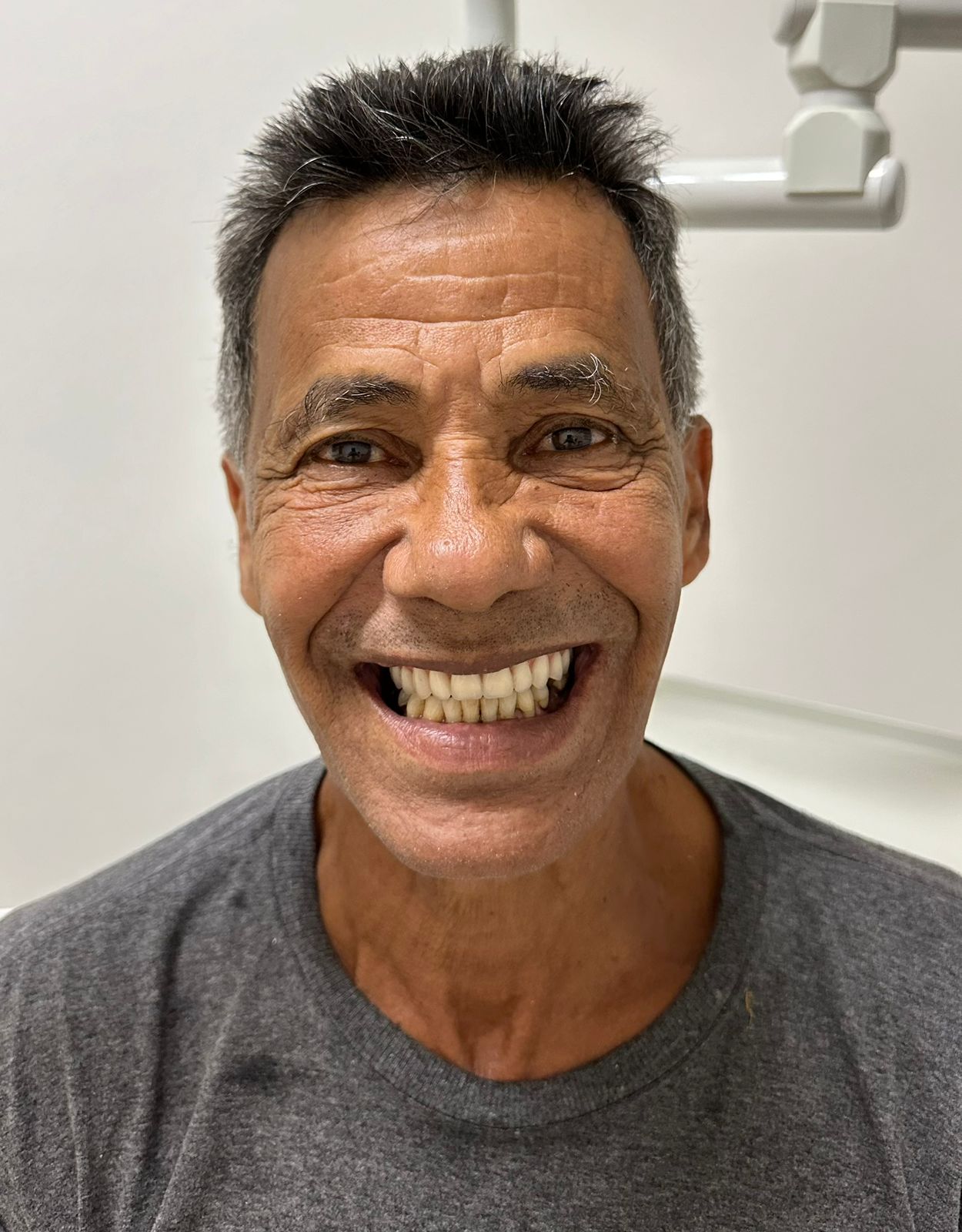 José Antonio após reabilitação oral com protocolo superior, sorriso completo.